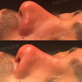 Before and after male rhinoplasty results at Memorial Şişli Hospital, nose reshaping outcome