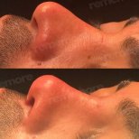 Before and after male rhinoplasty results at Memorial Şişli Hospital, nose reshaping outcome