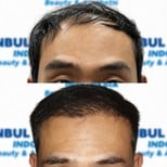 Before and after organic hair transplant results at Istanbul Hair Indonesia, improved hairline