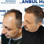 Résultats avant et après greffe de cheveux organique à Istanbul Hair Indonesia, ligne restaurée