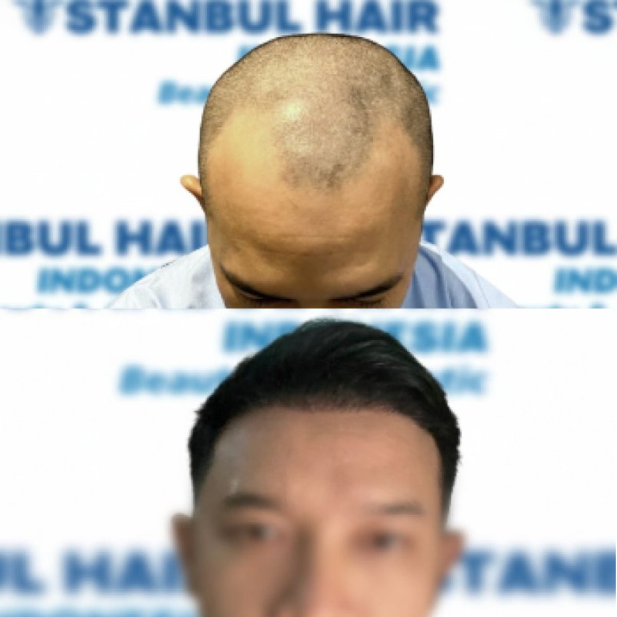 Resultados antes y después de trasplante capilar Sapphire FUE en Istanbul Hair Indonesia