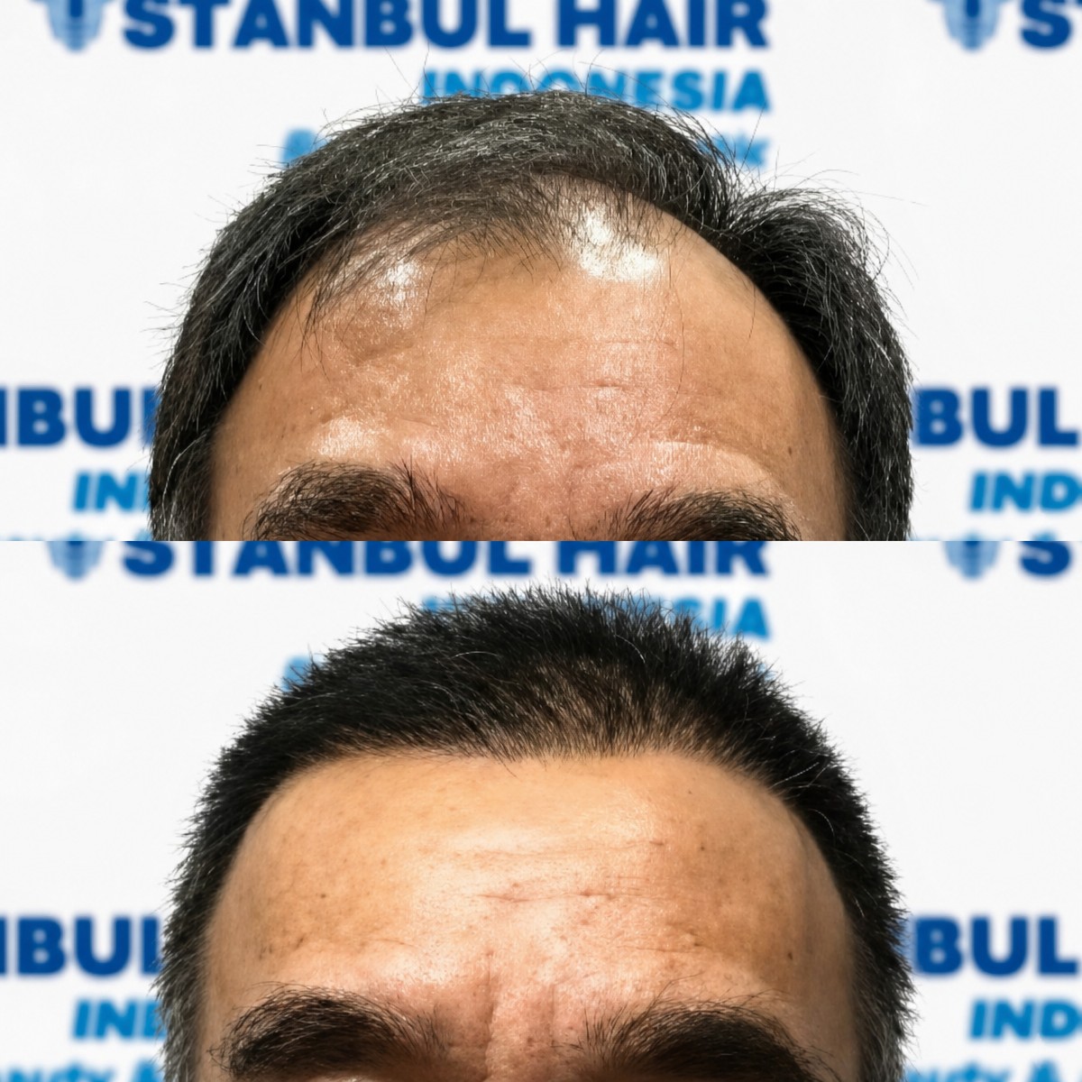 Resultados antes y después de trasplante capilar orgánico en Istanbul Hair Indonesia, línea restaurada
