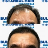 Before and after organic hair transplant results at Istanbul Hair Indonesia, restored hairline