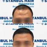 Before and after organic hair transplant results at Istanbul Hair Indonesia, improved hairline