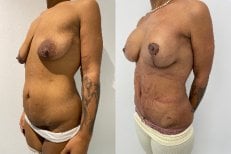 نتائج قبل وبعد عملية مامي ميك أوفر – شد الثدي والبطن وتحسن ملحوظ