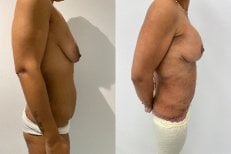 نتائج قبل وبعد عملية تجميل الأم – تحسين شكل البطن والثدي