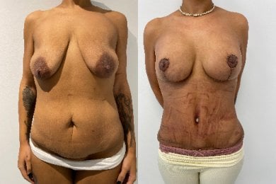 نتائج قبل وبعد عملية مامي ميك أوفر – شد الثدي وتحسين شكل البطن