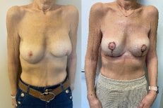 Before and after breast implants with lift results, improved breast shape and symmetry