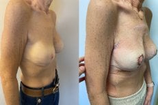 Before and after breast implants with lift results, improved breast shape and contour