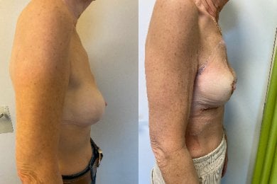 Before and after breast implants with lift results – improved breast shape and contour