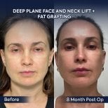 Before and after facelift and neck lift with fat grafting results at Dr. Safa Manav Clinic