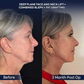 Facelift and neck lift before and after results at Dr. Safa Manav Clinic, visible rejuvenation