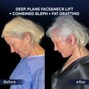 Before and after facelift, neck lift, blepharoplasty, and fat grafting at Dr. Safa Manav Clinic