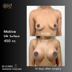 Vorher-nachher-Ergebnis Brustvergrößerung mit Motiva 450cc bei ID Clinic Bangkok