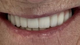 Результат імплантації All-on-4 у Smile Terminal Dental Care – відновлена посмішка