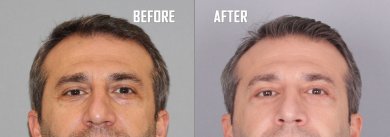 Before and after lower eyelid blepharoplasty results at Quartz Hospital, reduced eye bags