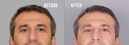 Before and after lower eyelid blepharoplasty results at Quartz Hospital, reduced eye bags