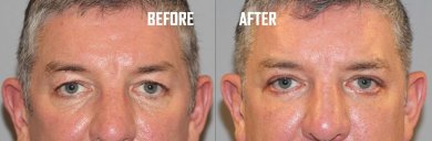 Before and after lower eyelid blepharoplasty results at Quartz Hospital, rejuvenated eye area