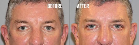 Before and after lower eyelid blepharoplasty results at Quartz Hospital, rejuvenated eye area