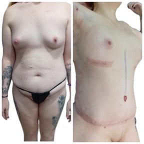 Before and after tummy tuck results at Hospital de la Familia, visible abdominal contouring