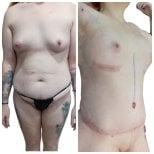 Before and after tummy tuck results at Hospital de la Familia, visible abdominal contouring