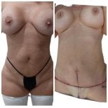 Before and after tummy tuck results at Hospital de la Familia, visible abdominal contouring