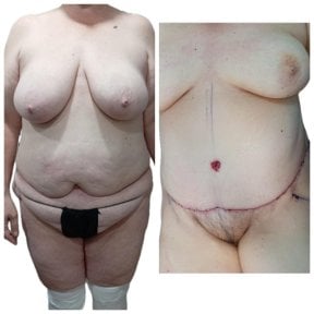 Before and after tummy tuck results at Hospital de la Familia, visible abdominal contouring