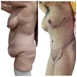 Before and after tummy tuck results at Hospital de la Familia, improved abdominal contour