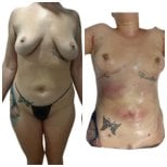 صور قبل وبعد شفط الدهون للدكتور 