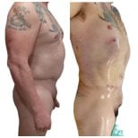 صور قبل وبعد شفط الدهون للدكتور 