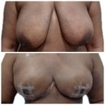 Before and after breast lift results at Hospital de la Familia, improved breast contour