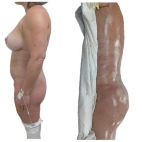 Before and after Brazilian Butt Lift results at Hospital de la Familia, enhanced body contour
