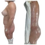 Before and after Brazilian Butt Lift results at Hospital de la Familia, enhanced body contour