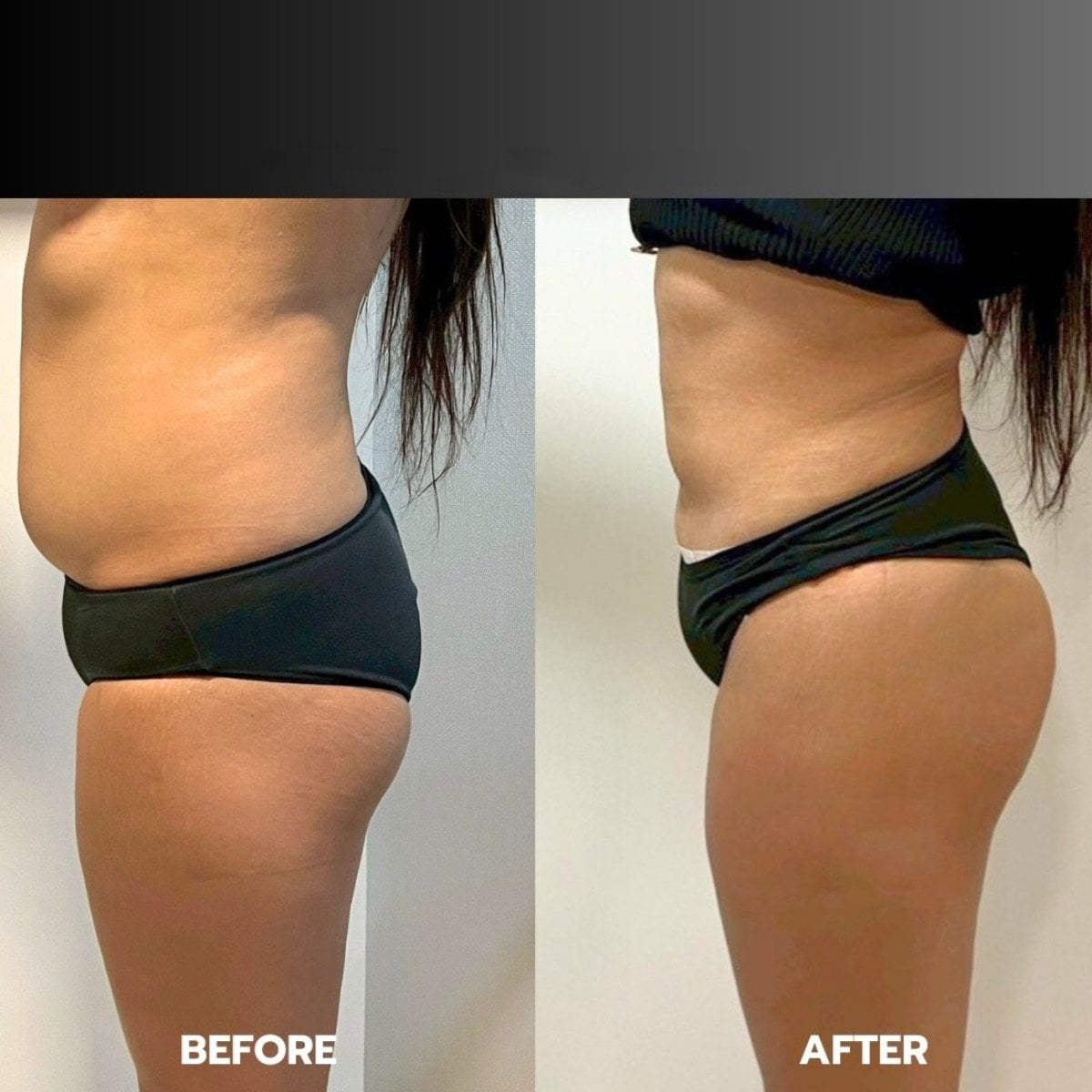 Antes y después de lifting de glúteos en ID Clinic Bangkok, mejora visible del contorno
