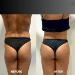 Before and after buttock lift results at ID Clinic Bangkok, visible gluteal contour improvement