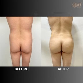 Before and after buttock lift results at ID Clinic Bangkok, improved contour and firmness