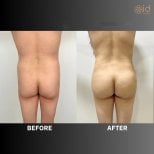 Before and after buttock lift results at ID Clinic Bangkok, improved contour and firmness