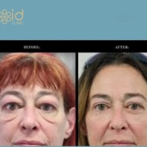 Before and after droopy eyelid surgery results at ID Clinic Bangkok, improved eye appearance