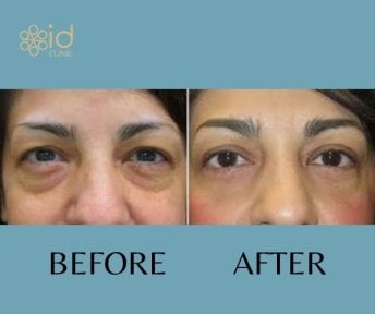 Before and after droopy eyelid surgery results at ID Clinic Bangkok, improved eye appearance