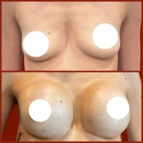 Before and after breast augmentation results at DGB Clinic, enhanced breast volume and shape