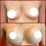 Before and after breast augmentation results at DGB Clinic, enhanced breast volume and shape