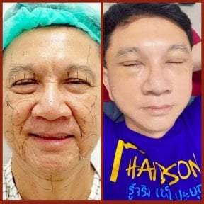 نتائج شد الوجه قبل وبعد في DGB Clinic – تجديد شباب الوجه وبشرة أكثر نعومة