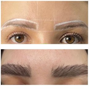 Vorher-nachher-Ergebnis der Augenbrauentransplantation bei Adem and Havva Medical Center, dichtere Brauen