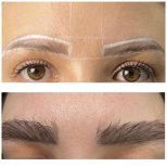 Vorher-nachher-Ergebnis der Augenbrauentransplantation bei Adem and Havva Medical Center, dichtere Brauen