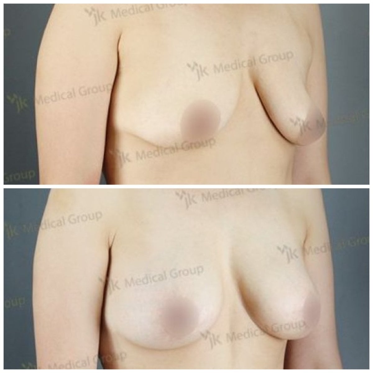Resultados antes y después de mommy makeover en JK Plastic Surgery Center, levantamiento de senos