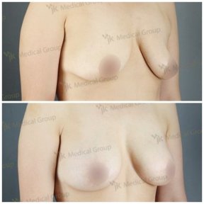 Vorher-nachher-Ergebnis Mommy Makeover bei JK Plastic Surgery Center, Bruststraffung und Kontur