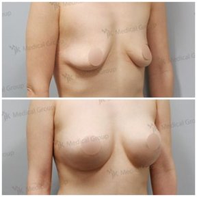 Vorher-nachher Mommy Makeover bei JK Plastic Surgery Center, sichtbares Brustvergrößerungsergebnis
