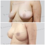 Vorher-nachher-Ergebnis Mommy Makeover bei JK Plastic Surgery Center, Bruststraffung