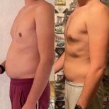 Before and after abdominal liposuction results at Dr. Safa Manav Clinic, visible fat reduction