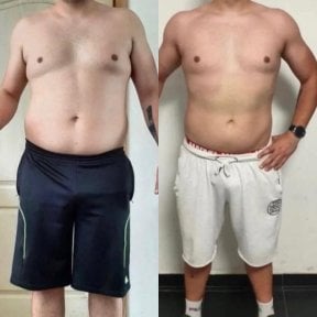 Before and after abdominal liposuction results at Dr. Safa Manav Clinic, improved body contour